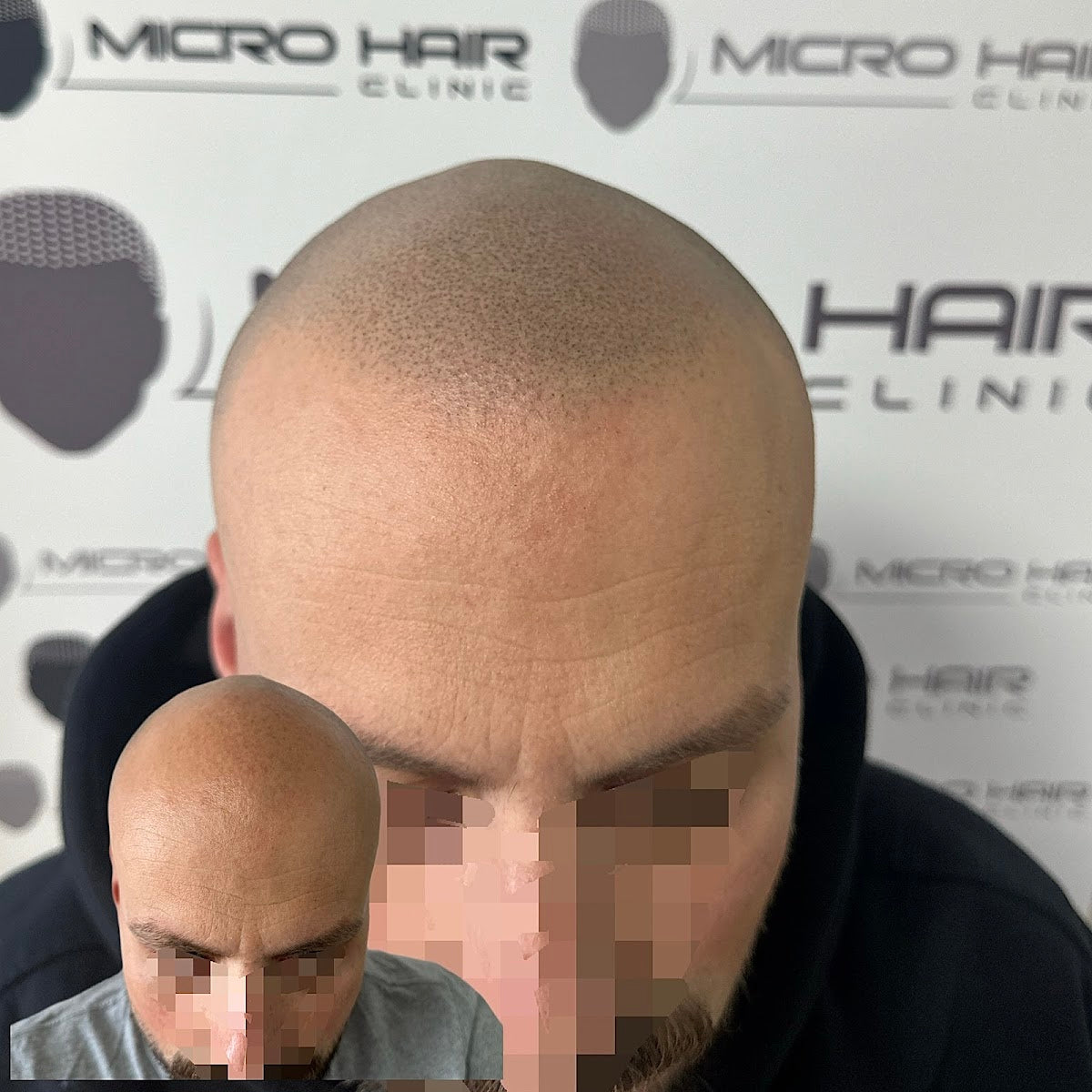 Micro hair clinic - Hair Transplant clinic in Beograd, Serbia