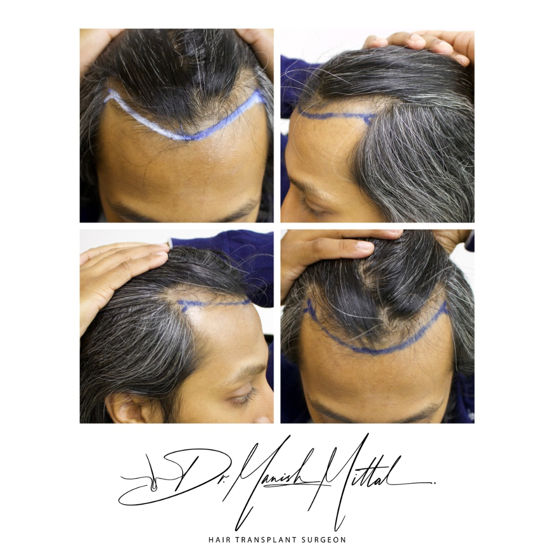 Mittal Hair Clinic — Dr.Visor photo 5