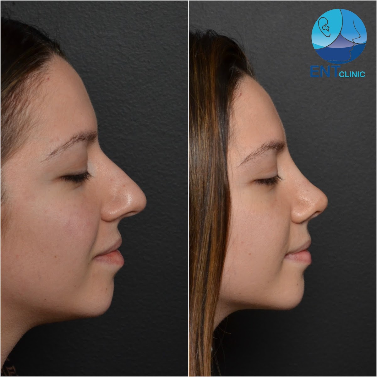 ENT Clinic Albania Rhinoplasty, Plastic Surgery - Aesthetic Surgery clinic in Tiranë, Albania