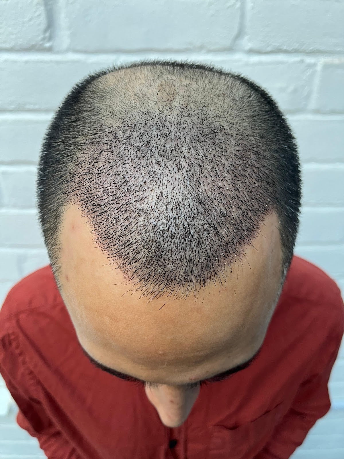Mittal Hair Clinic — Dr.Visor