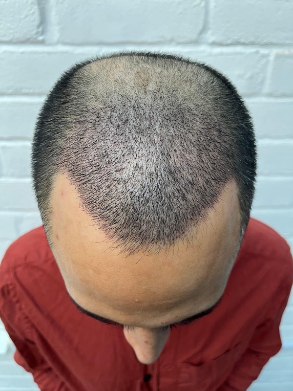 Mittal Hair Clinic