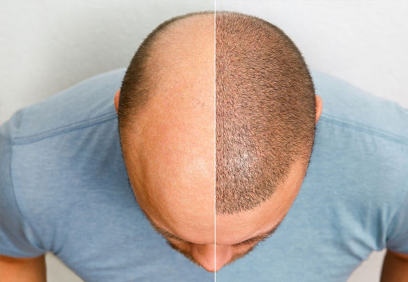 Antalya Hair Transplant in Turkey — Dr.Visor photo 3