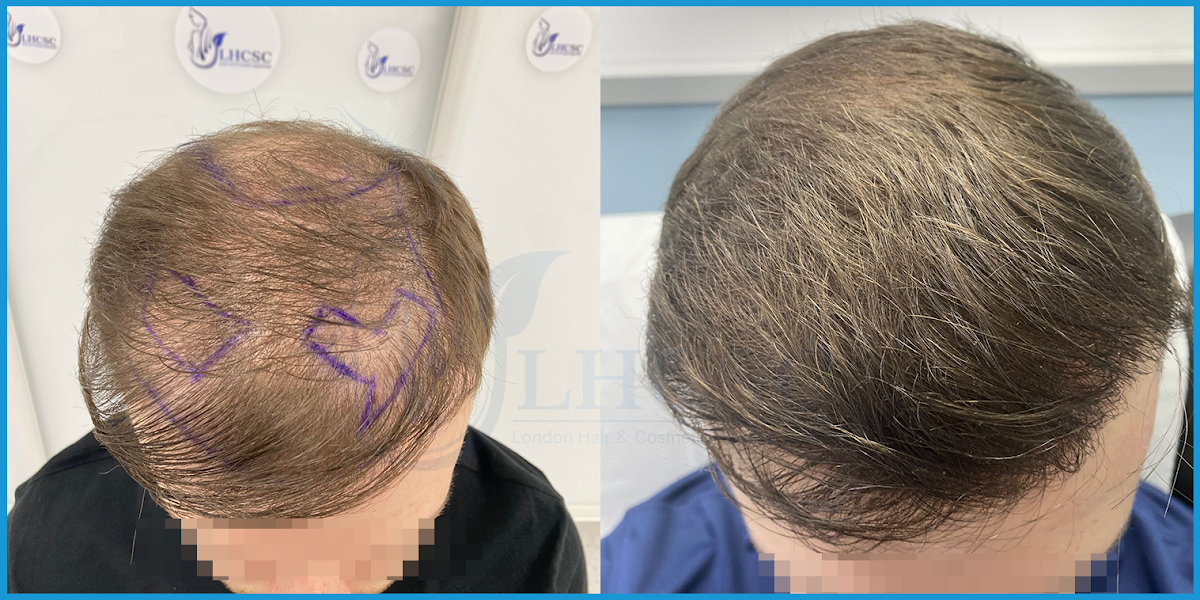London Hair Transplant Clinic — Dr.Visor photo 5