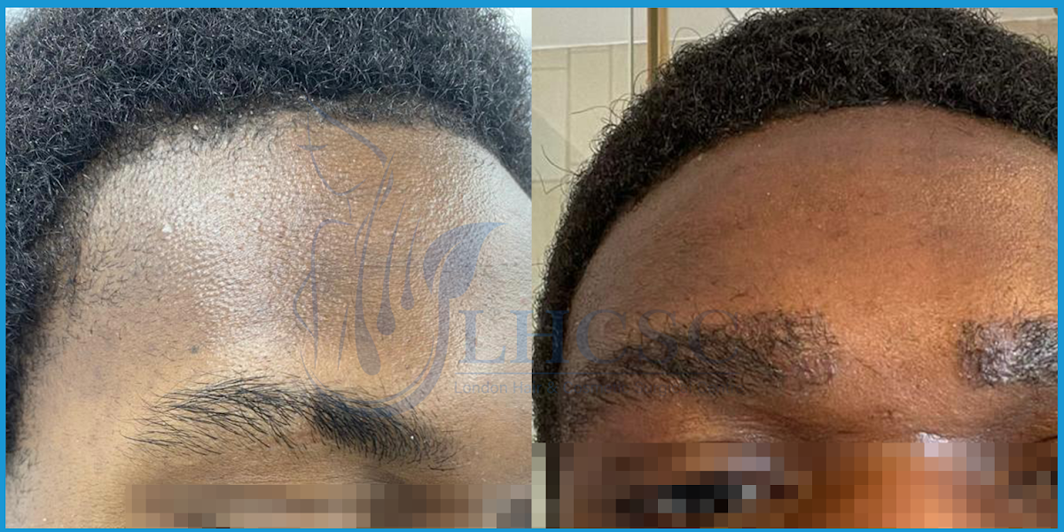 London Hair Transplant Clinic — Dr.Visor photo 3