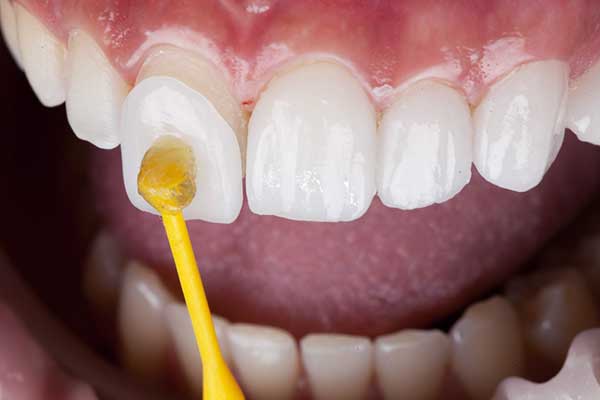 dental clinic istanbul turkey - Implant Treatment - veneers — Dr.Visor photo 3