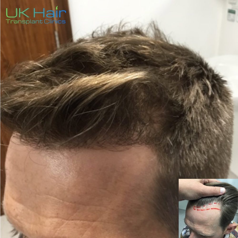 UK Hair Transplant Clinics Leeds — Dr.Visor photo 3