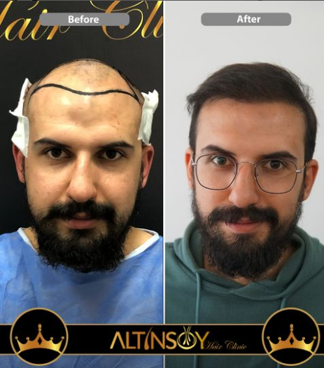 Hair Transplant Of Antalya / Antalya Saç Ekimi / Altınsoy Hair Clinic — Dr.Visor photo 3