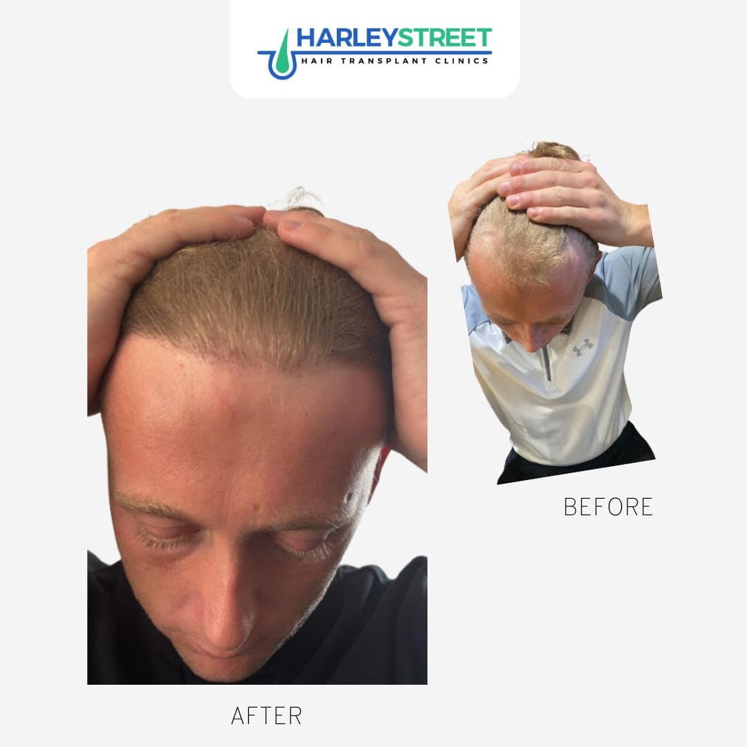 Hair Transplant Leeds — Dr.Visor photo 4