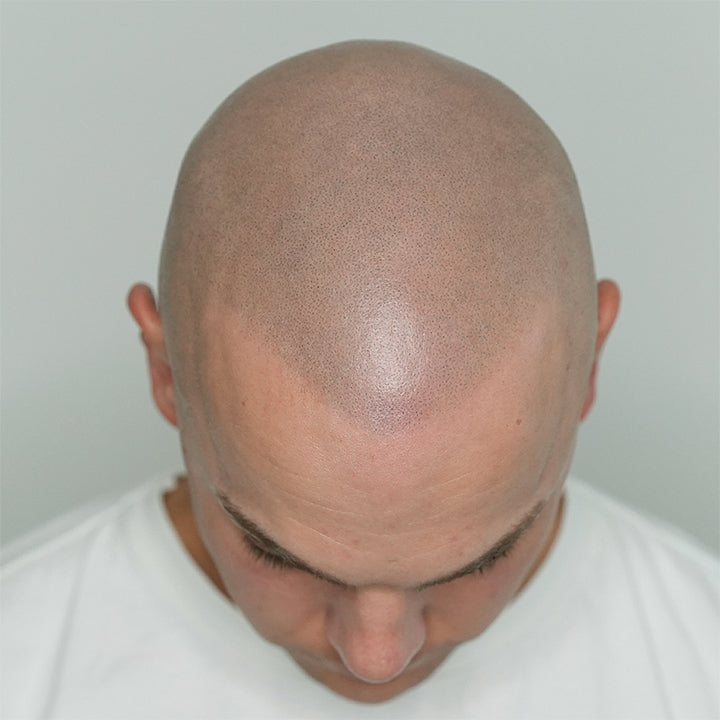 Skalp | Manchester Scalp Micropigmentation Clinic — Dr.Visor photo 2