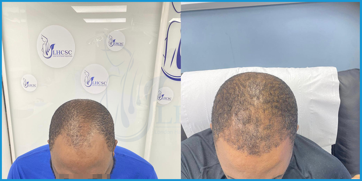 London Hair Transplant Clinic — Dr.Visor photo 4