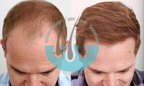 Micro Fue Turkey Gumbet — Dr.Visor photo 4