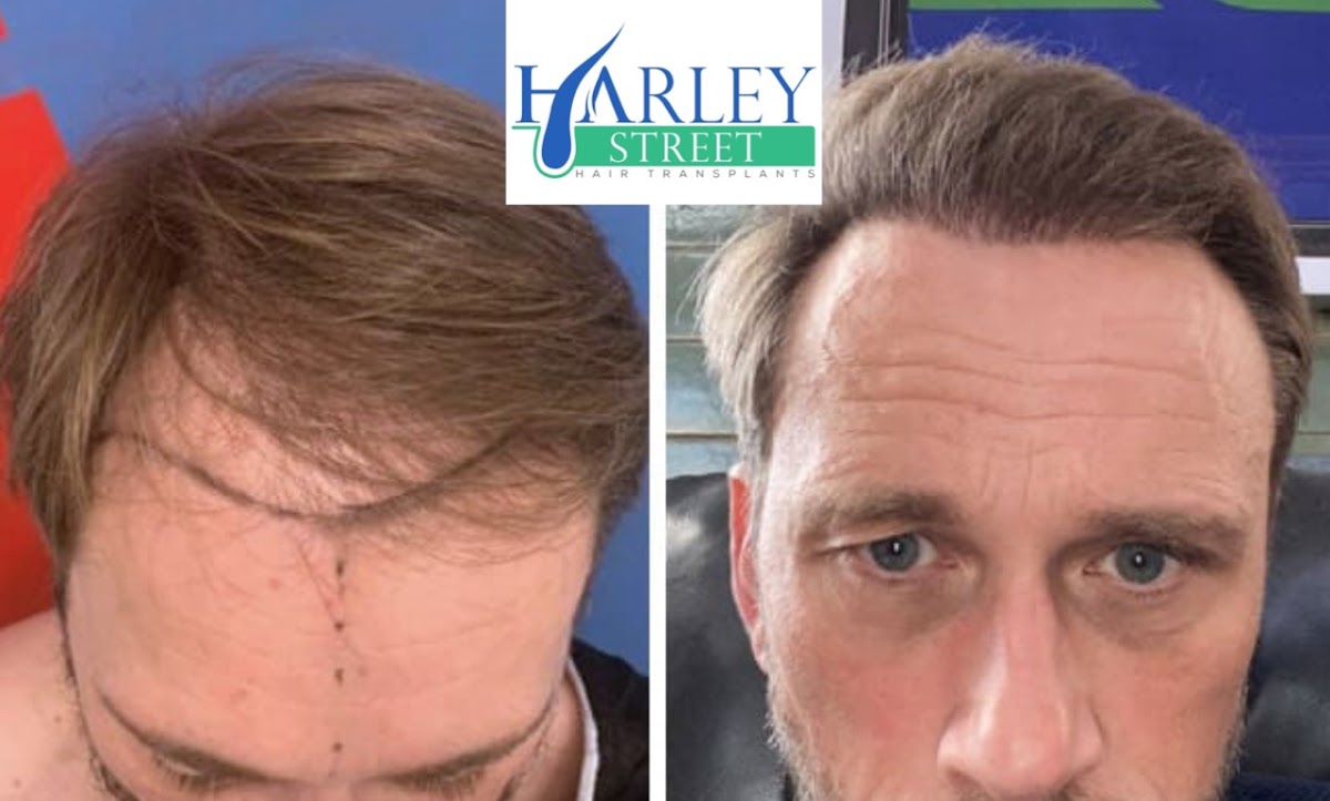 Edinburgh Hair Transplant Clinics — Dr.Visor photo 5