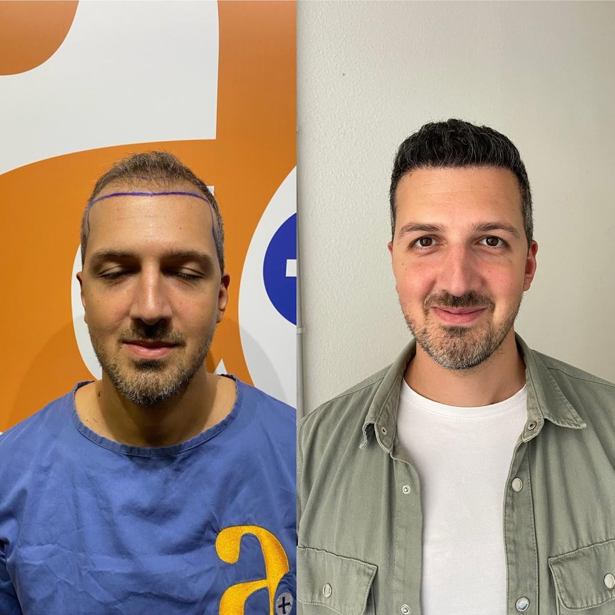 Ultrahairtransplant — Dr.Visor photo 5