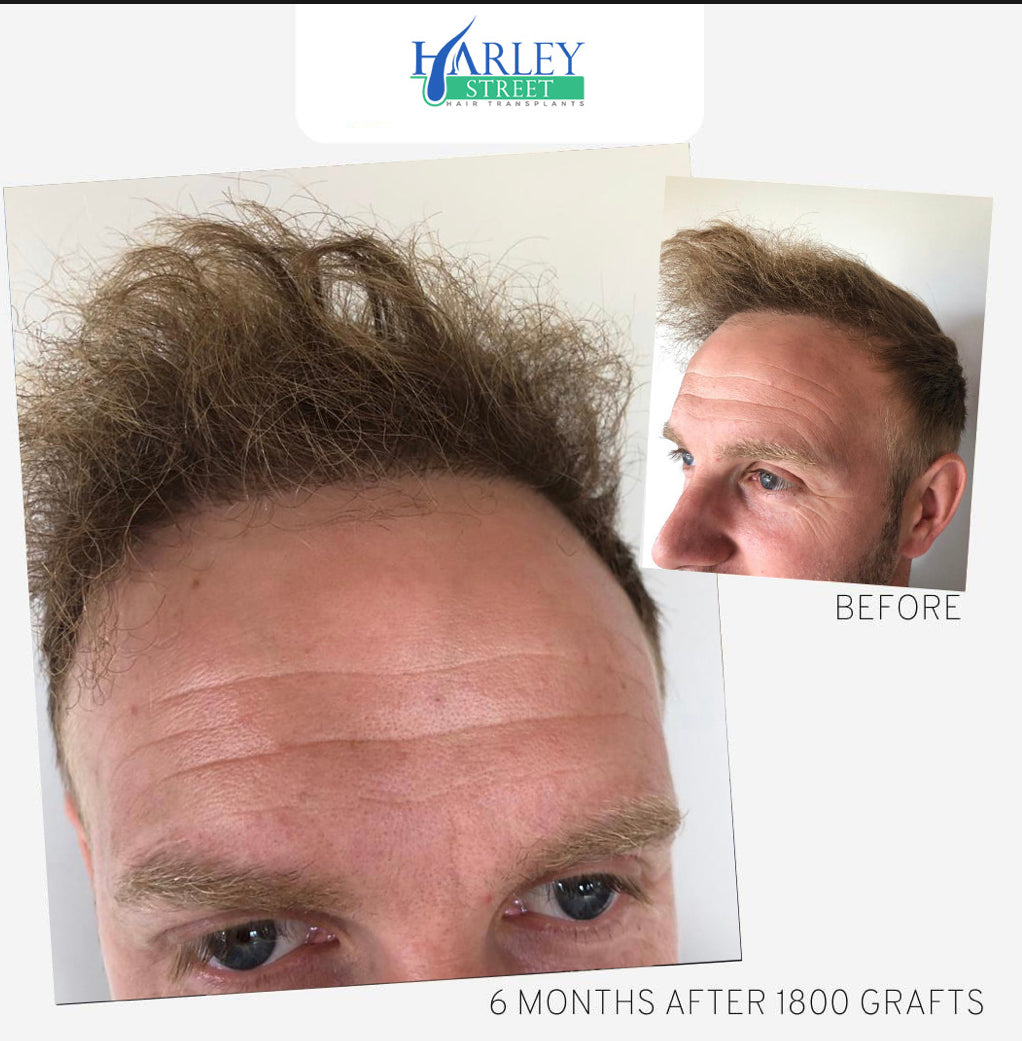 Manchester Hair Transplants Clinics — Dr.Visor photo 4