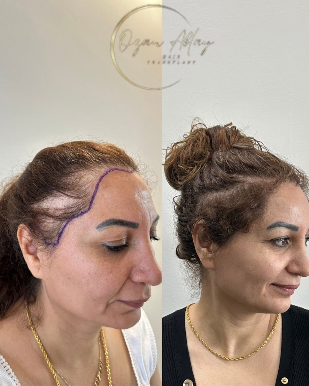 Ozan Ablay Hair Transplant — Dr.Visor photo 3