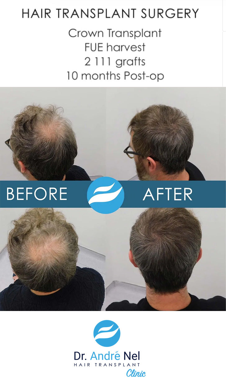 Dr. André Nel Hair Transplant Clinic — Dr.Visor photo 5