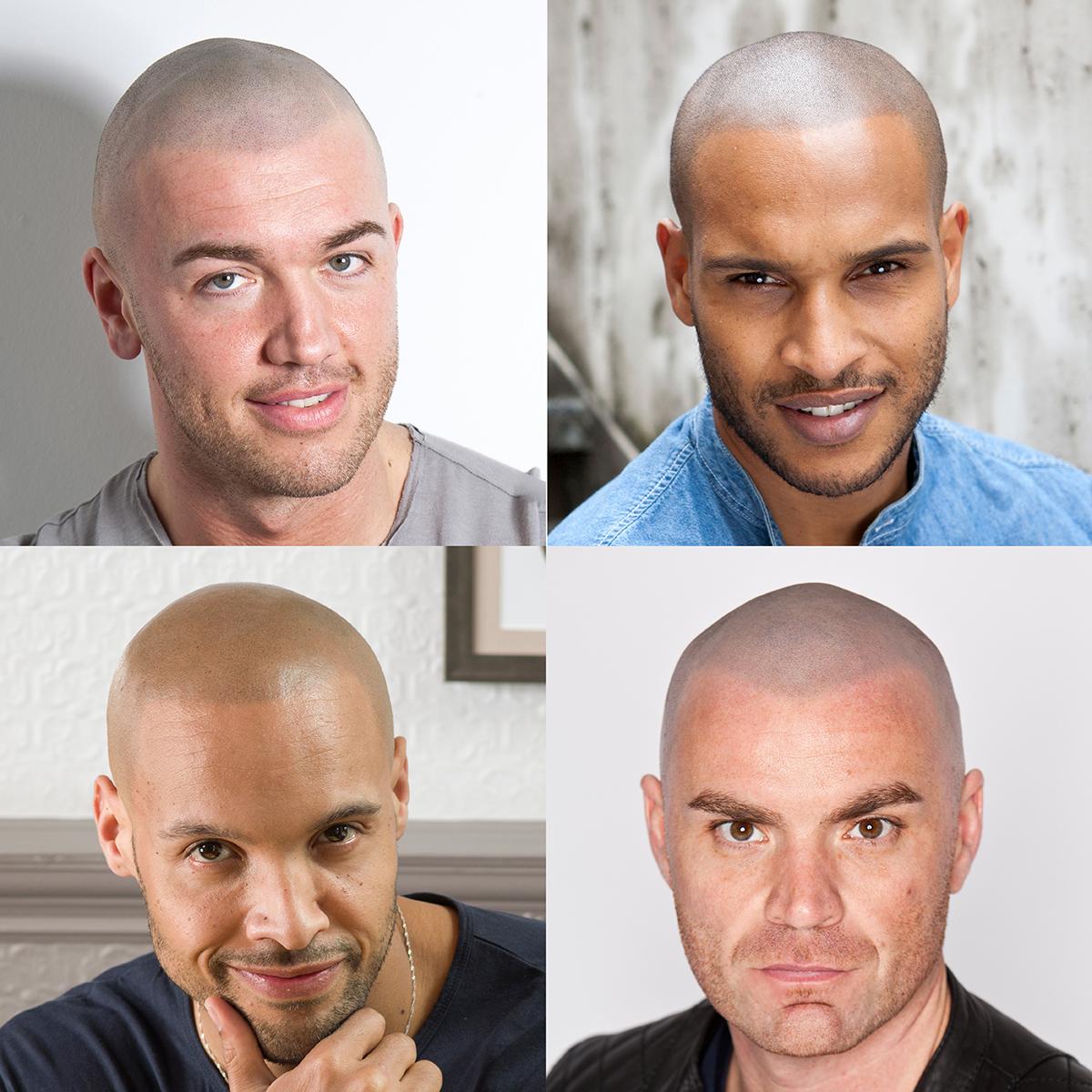 Skalp | Manchester Scalp Micropigmentation Clinic — Dr.Visor photo 4