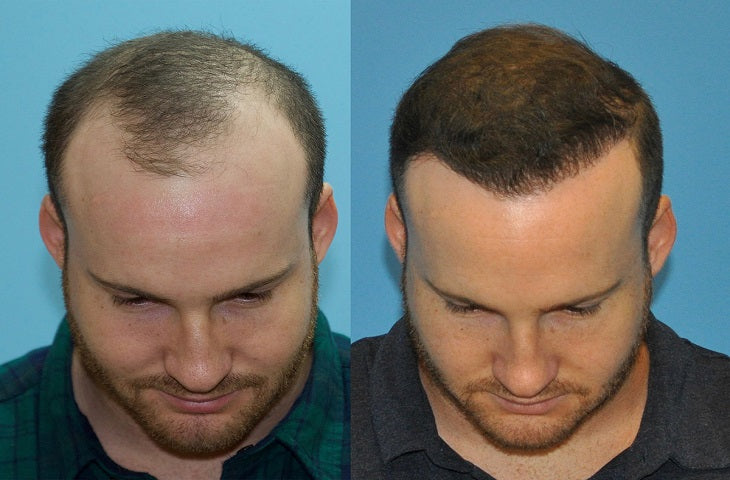 Antalya Hair Transplant in Turkey — Dr.Visor photo 5