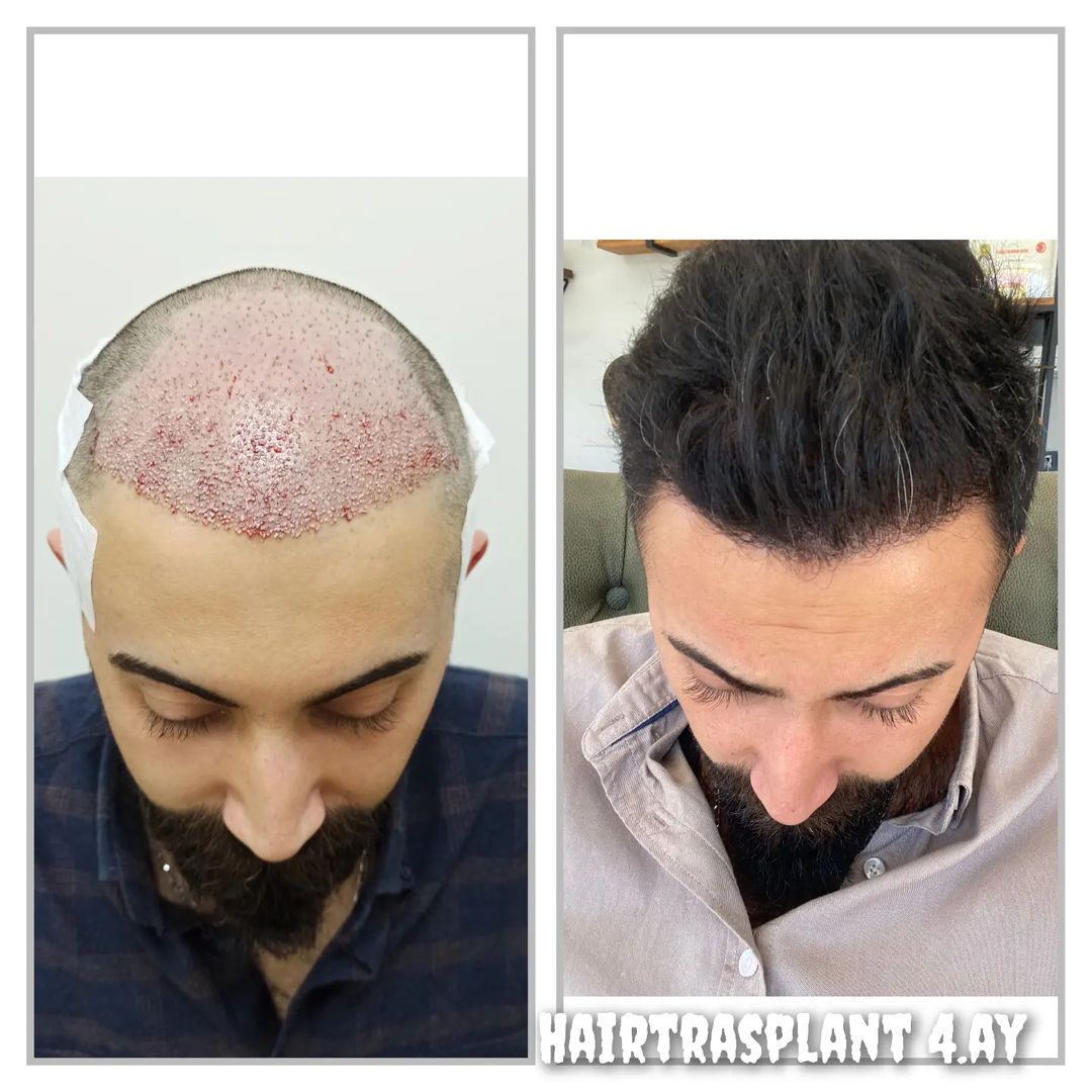 İzmir Saç Ekimi Merkezi - Hisstohair | Fue saç ekimi | PRP ve Mezoterapi | Sakal ekimi | Kaş ekimi — Dr.Visor photo 4