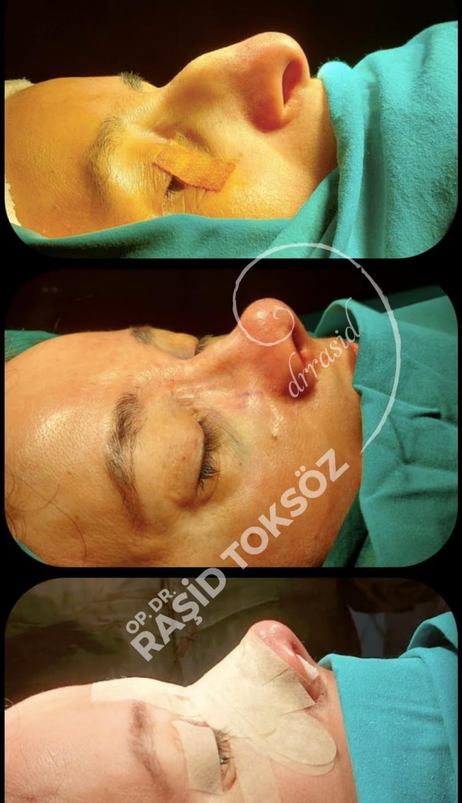 Op. Dr. Raşid Toksöz | Burun Estetiği Ankara | Plastik Cerrahi - Ankara Meme Estetiği - Plastik Cerrahi Uzmanı — Dr.Visor photo 3