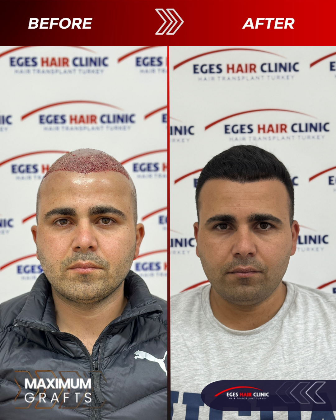 Bodrum Saç Ekim Merkezi | Bodrum Hair Transplant — Dr.Visor photo 5