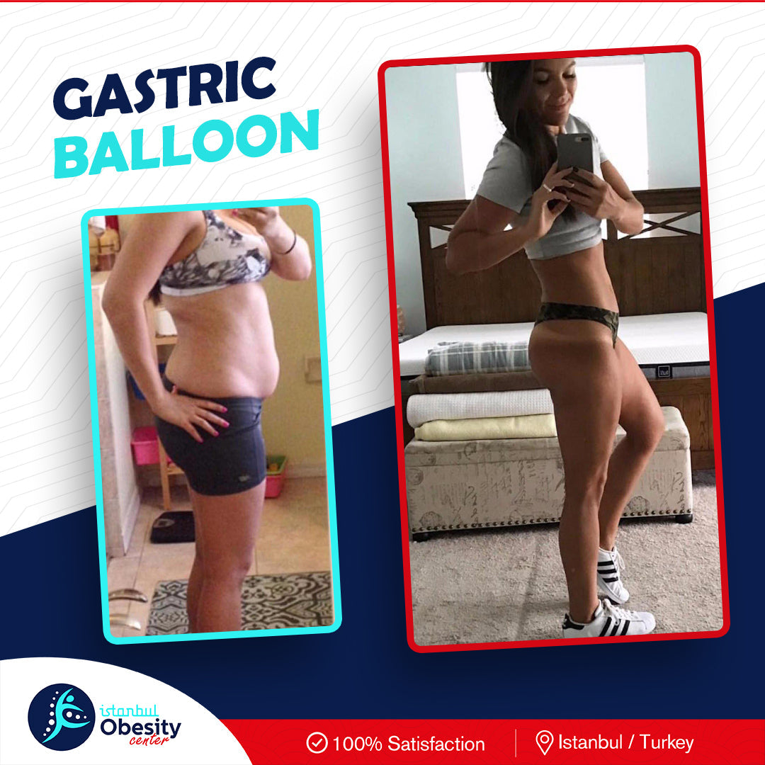 Istanbul Obesity Center | Gastric Sleeve, Gastric Balloon & Bariatric Surgery in Turkey — Dr.Visor photo 3