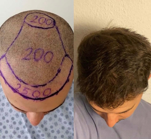 Best hair transplant clinic Manchester
