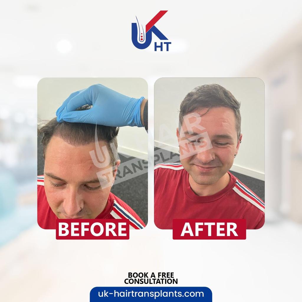 UK Hair Transplants UKHT Manchester — Dr.Visor photo 4