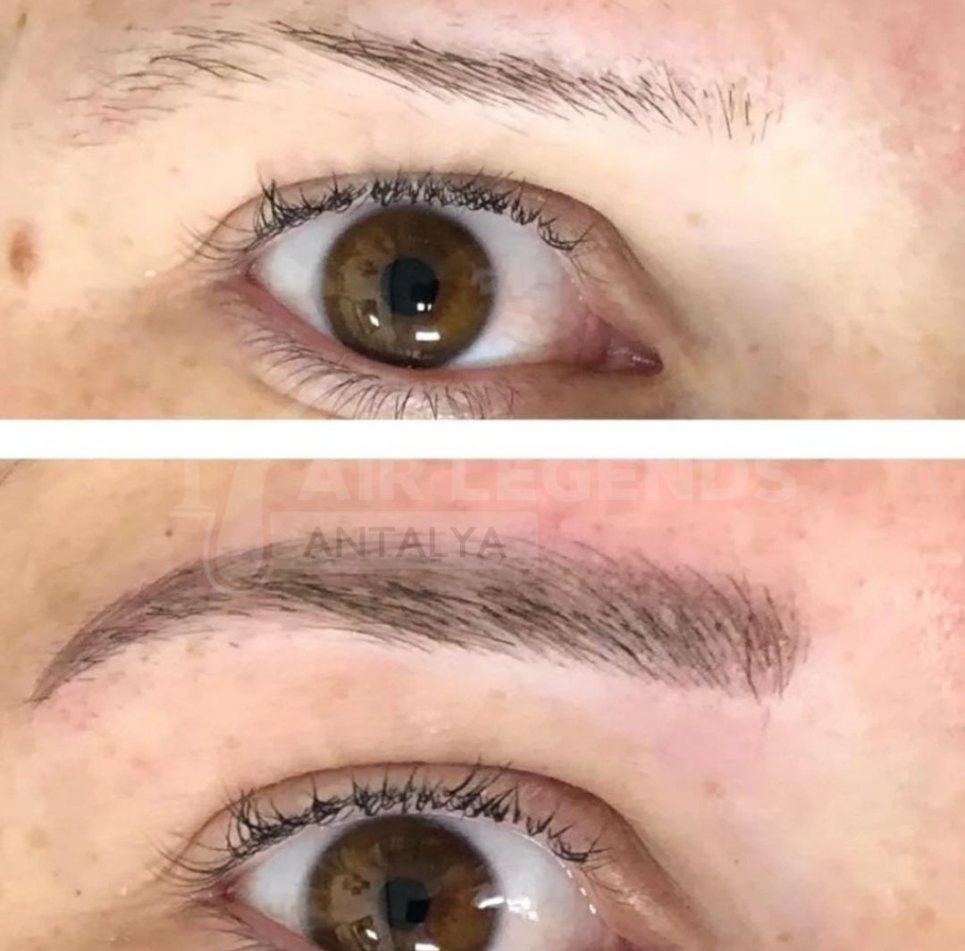 Hair Legends | Hair Transplant Antalya — Dr.Visor photo 4