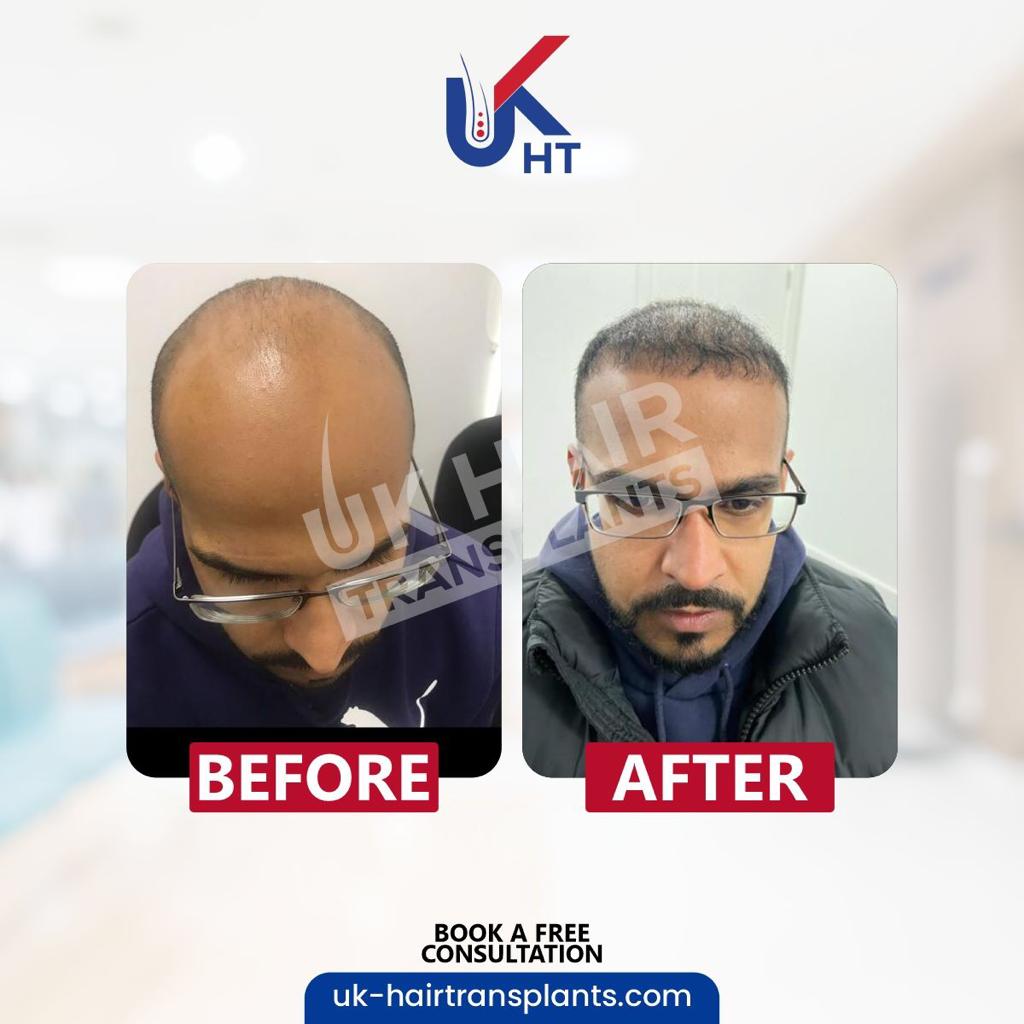 UK Hair Transplants UKHT Manchester — Dr.Visor photo 5