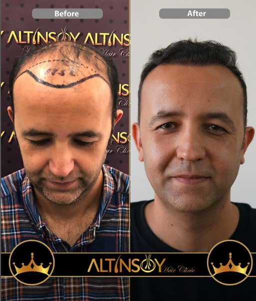 Hair Transplant Of Antalya / Antalya Saç Ekimi / Altınsoy Hair Clinic — Dr.Visor photo 2