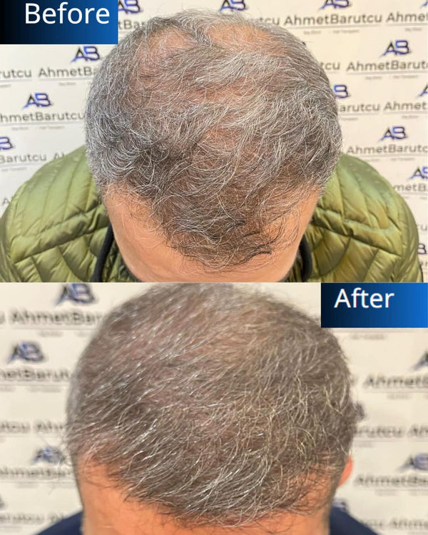 Ahmet Barutcu Saç Ekimi / Hair Transplant