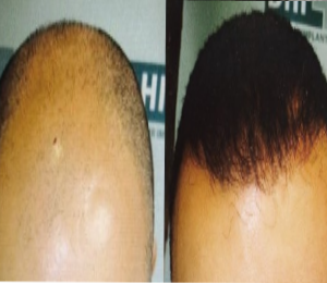 Beacon Hair Restoration Clinic — Dr.Visor photo 2