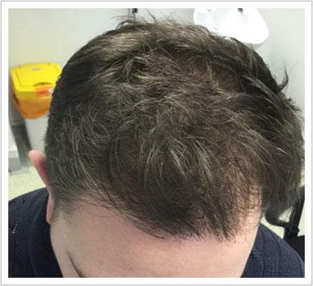 UK Hair Transplant Clinics Birmingham — Dr.Visor photo 4