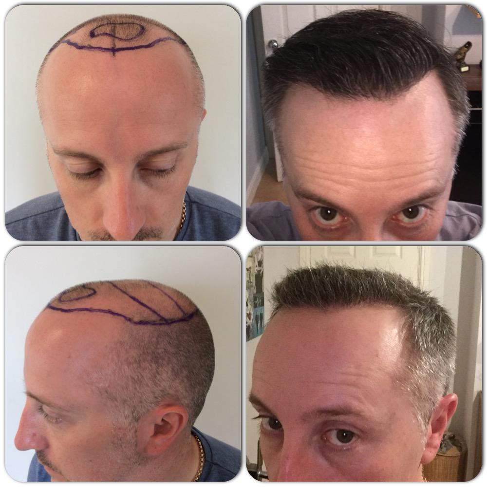 Capital Hair Restoration - Hair Transplant — Dr.Visor photo 3