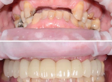 Fixed Teeth Solutions - Kent & London, United Kingdom