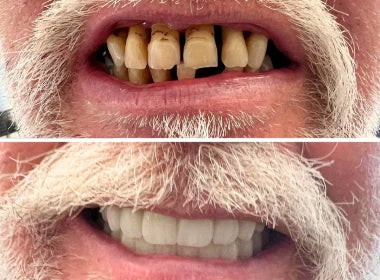 Fixed Teeth Solutions - Kent & London, United Kingdom