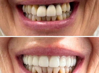 Fixed Teeth Solutions - Kent & London, United Kingdom