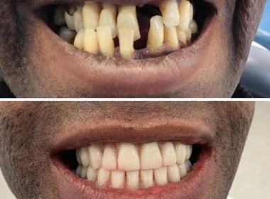 Fixed Teeth Solutions - Kent & London, United Kingdom