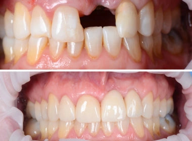 Fixed Teeth Solutions - Kent & London, United Kingdom