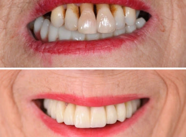 Fixed Teeth Solutions - Kent & London, United Kingdom